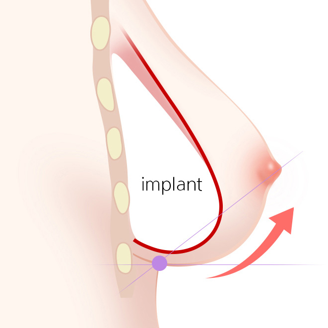 Breastfeeding after Breast Augmentation