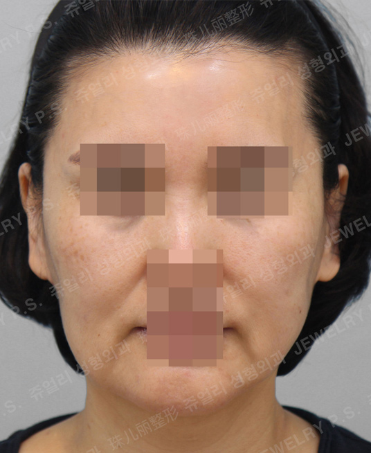 정면 before