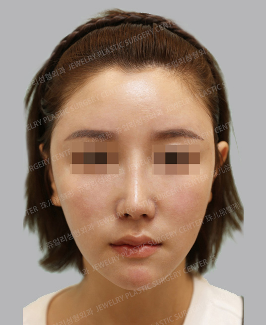 정면 after