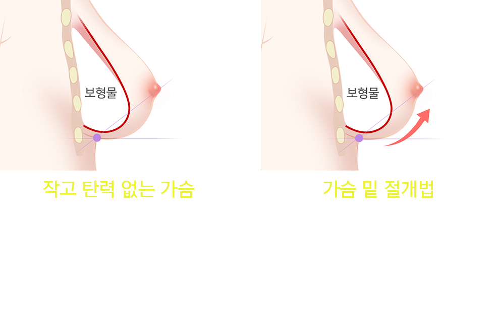 가슴성형 모유수유 : 후기/수술방법/통증/비용/보형물