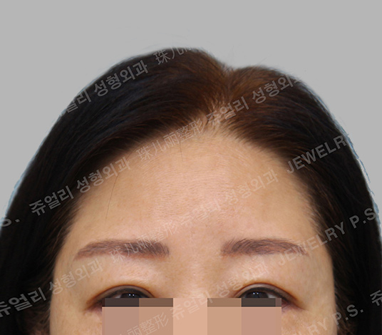 정면 after