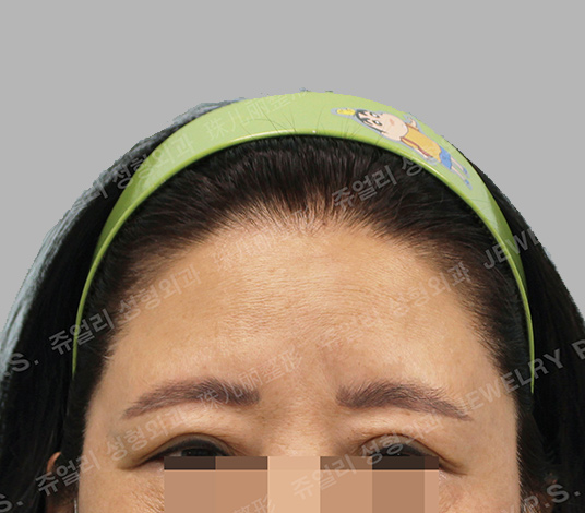 정면 before