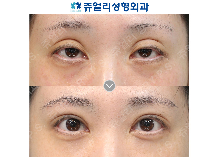 Revision double eyelid surgery (sausage eyelid/ptosis correction, multiple crease correction) + under-eye fat repositioning + aegyo-sal