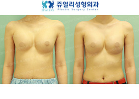 Breast Augmentation Reoperation