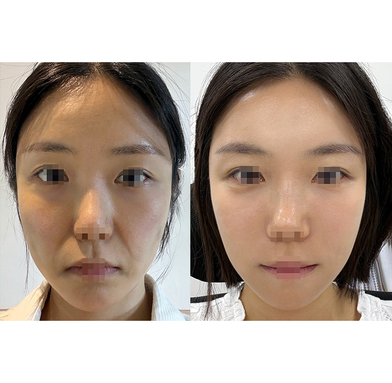 Anti-aging and lifting at Jewelry Plastic Surgery — Jewelry case #3185
