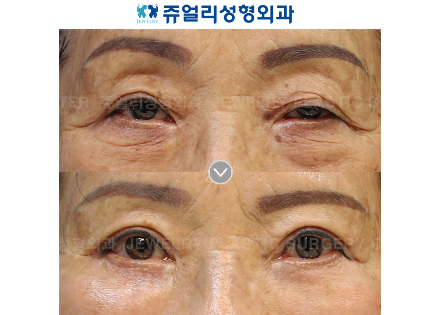 Aponeurotic Ptosis + Lower Blepharoplasty