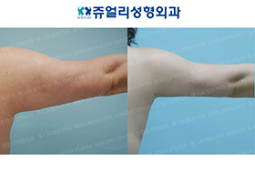 Arm Liposuction