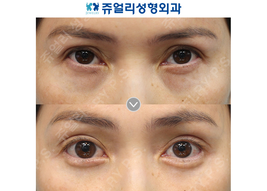 Upper blepharoplasty + lower blepharoplasty + lateral canthoplasty + lower canthoplasty