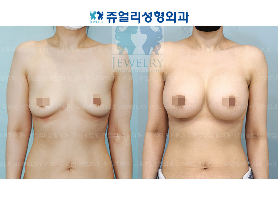 Breast Augmentation (400cc)