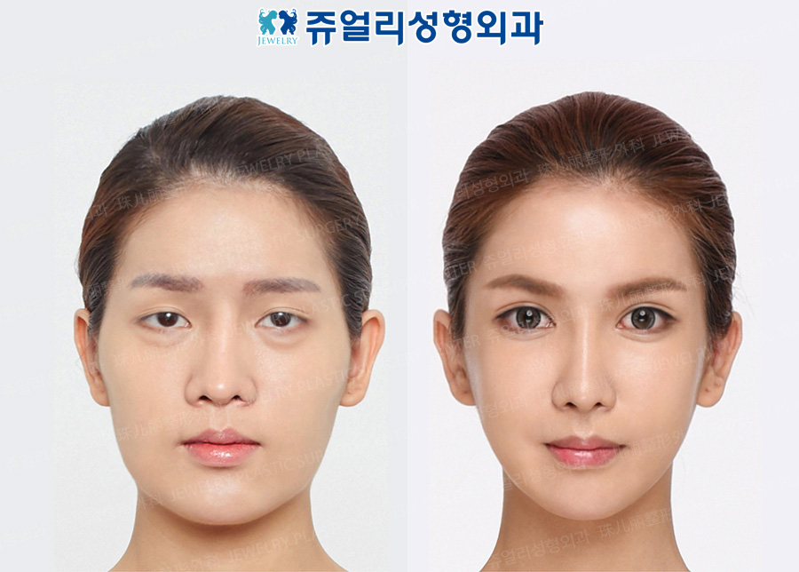 Double Eyelids (Ptosis)+Epicanthoplasty, Dark Circle Removal (Loveband Filler Removal)+Loveband, Nose Reoperation, Fat Grafting, Cheekbone Reduction+Square Jaw Reduction+T-osteotomy, Double Chin Liposuction