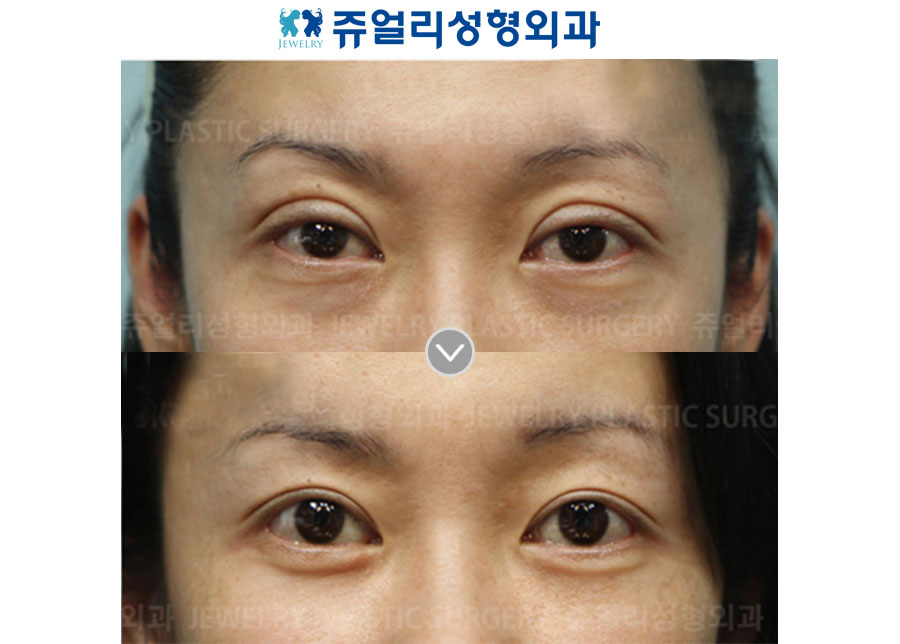 Double Eyelids Reoperation (Sausage Eyes)