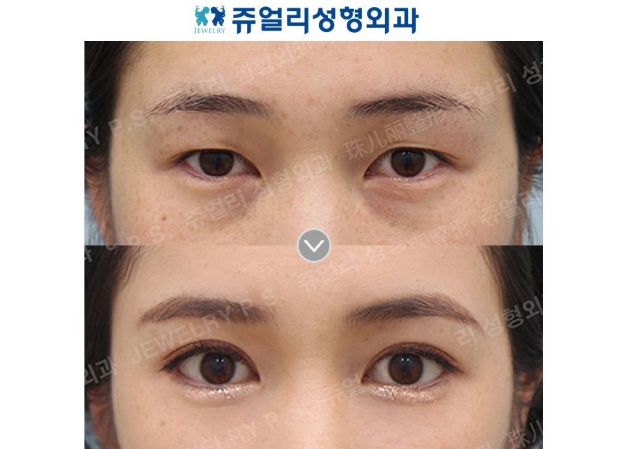 Double Eyelid, Dark Circle (Fat-Repositioning Transconjunctival Blepharo, Loveband X), Lower Lateral Canthoplasty/Lowering down the eyes tail