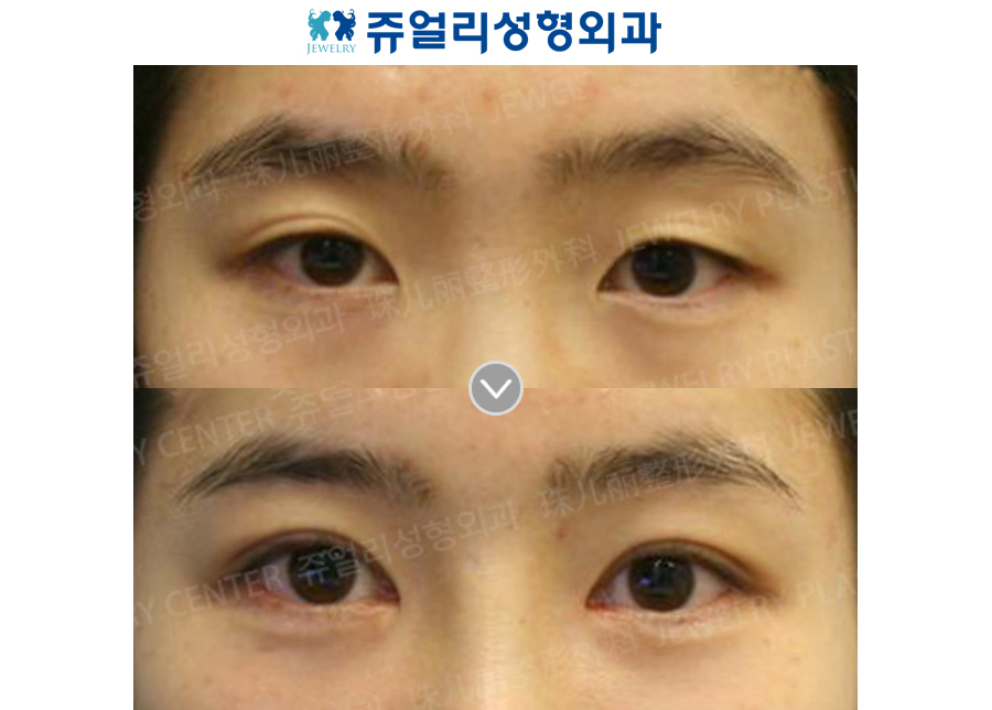 Double Eyelids Non-Incision