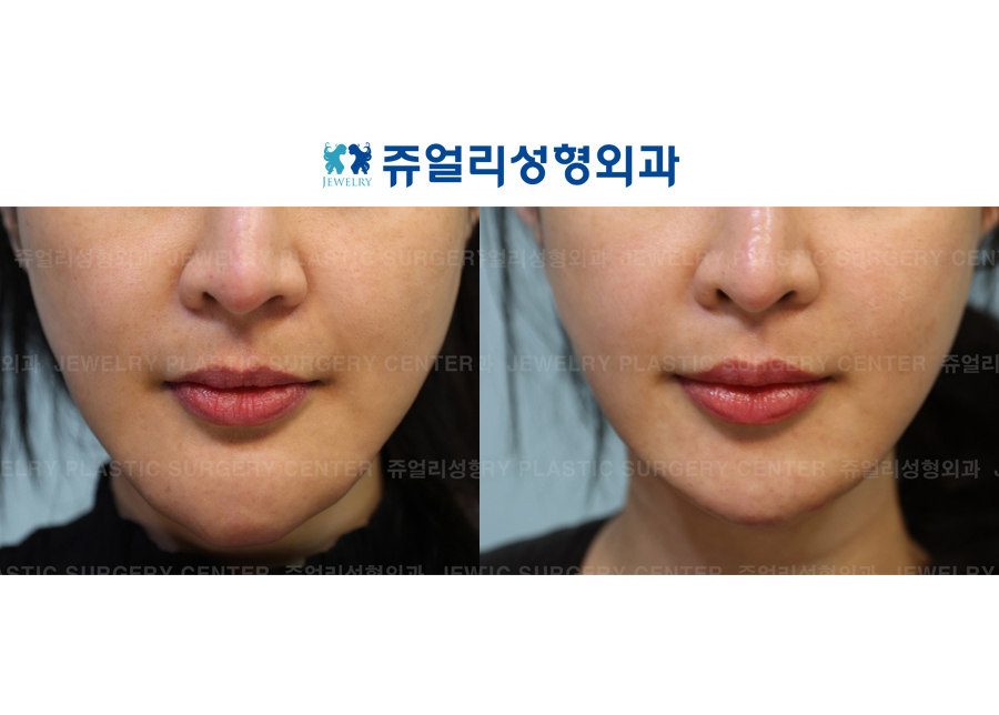 Removal of Foreign Substance of Front Chin Implant + Front Chin Muscle Lifting