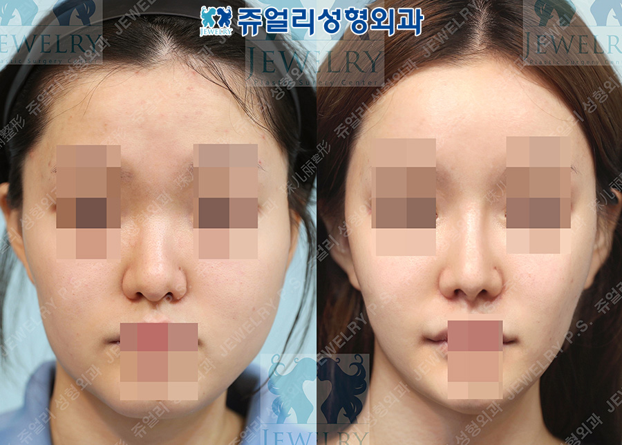 Rhinoplasty (silicone, septal cartilage, ear cartilage) + facial contouring (zygoma, square jaw, front chin) + fat grafting