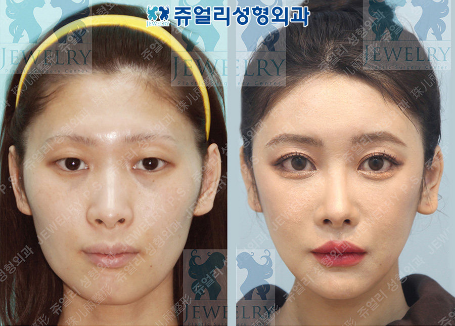 Eye surgery (natural double eyelid), under-eye fat repositioning + aegyo-sal, rhinoplasty, fat grafting, zygoma + square jaw + T-osteotomy