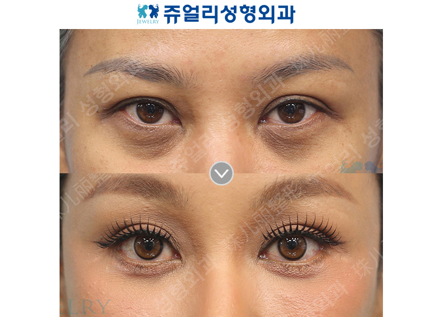 Lower blepharoplasty + lower canthoplasty