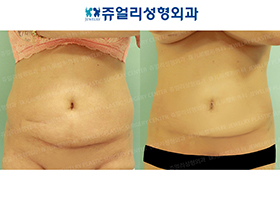 Abdominal Wall Surgery + Liposuction