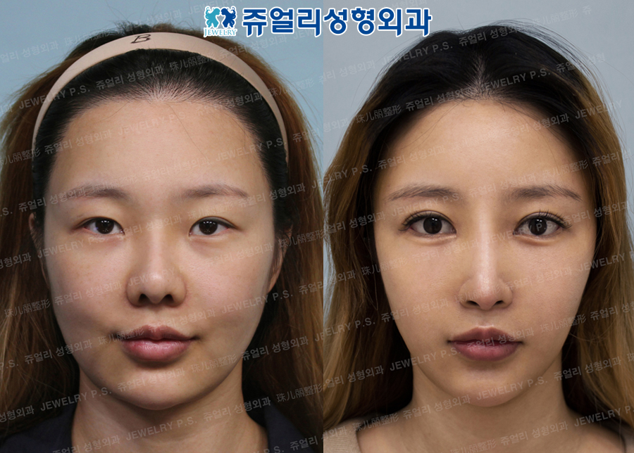 korean plastic surgery before and after jaw