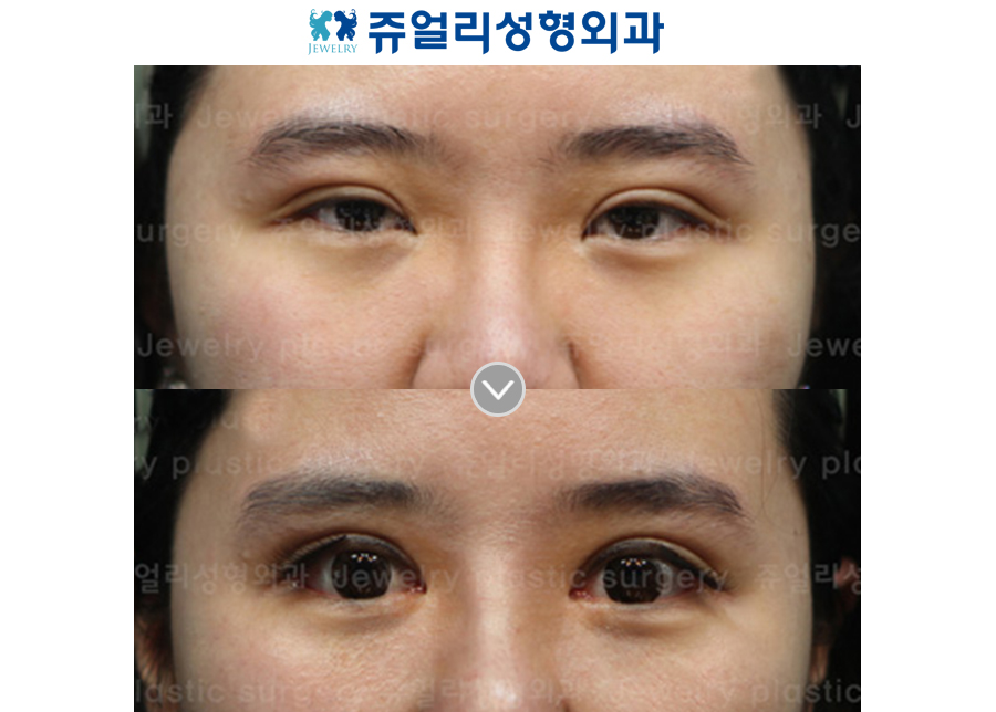Ptosis