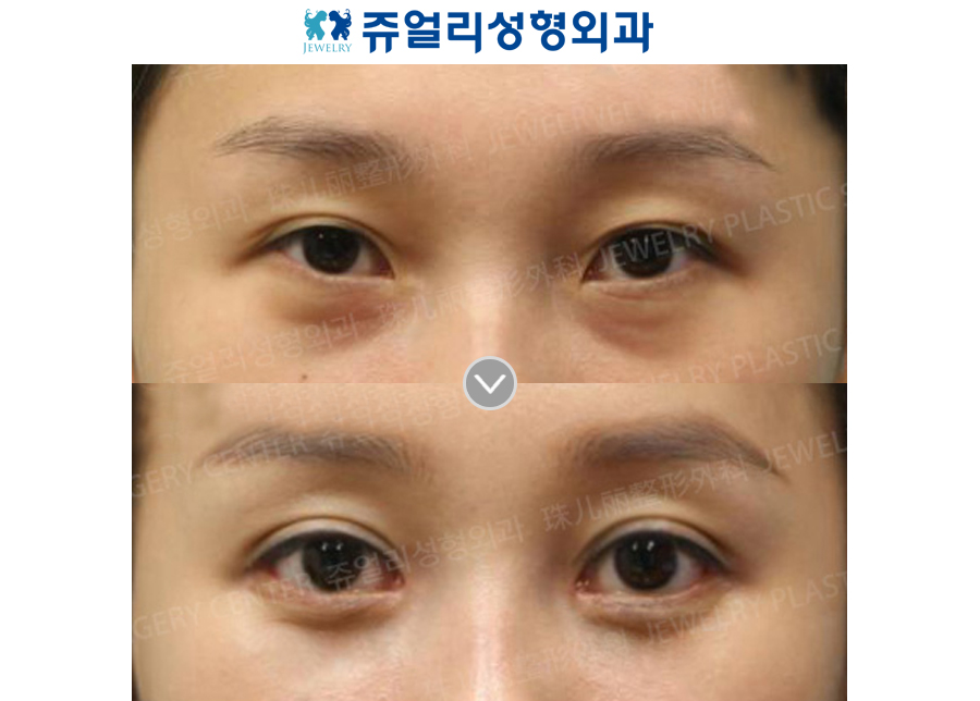 Ptosis Correction + Ptosis