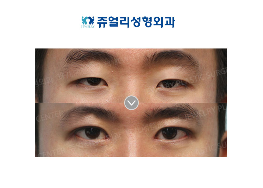 Ptosis + Epicanthoplasty
