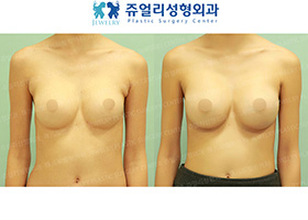 Breast Augmentation