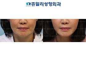 Mini Lifting (Jaw Line Lifting)