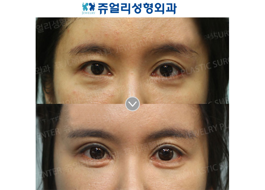 Double Eyelids (Asymmetrical Eyes) + Dark Circle + Loveband