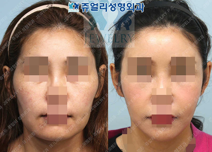 Face Lifting+Double Chin Liposuction