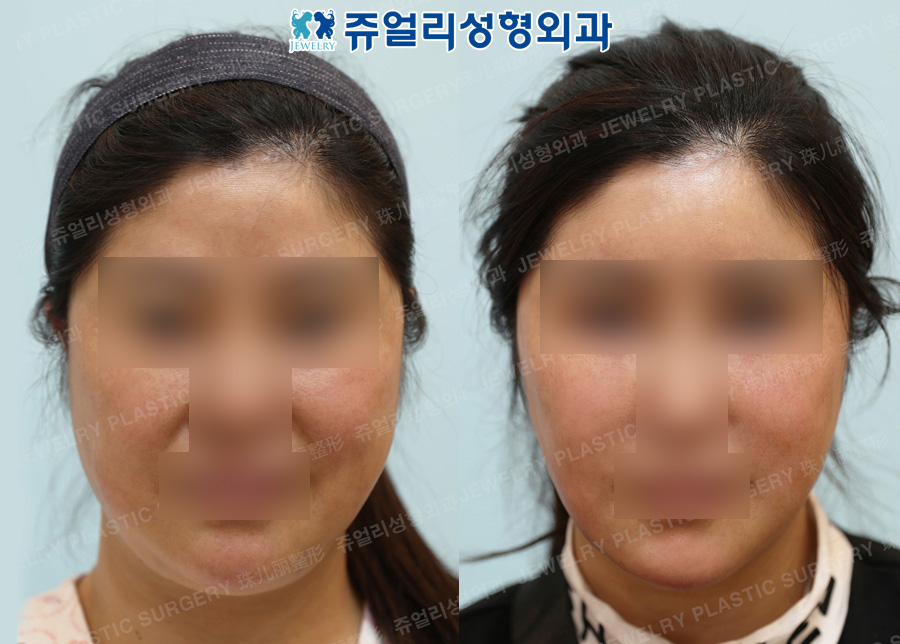 Forehead + Double Chin Liposuction, Mini Lifting, Chin Botox