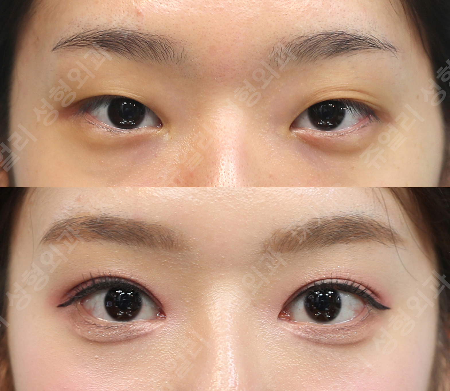 Double eyelid surgery (non-incisional)