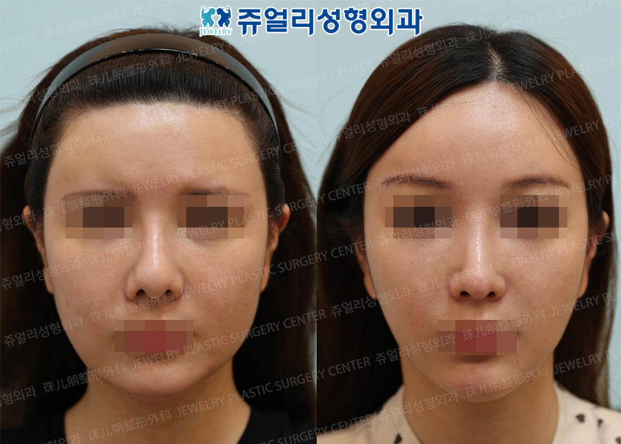 Forehead Lifting, Nose Reoperation, Cheek + Jaw Liposuction, Square Jaw Reduction + Chin Advancement Surgery