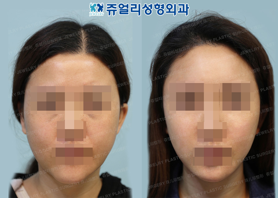 Double Chin + Cheek Liposuction, Front Chin Muscle Lifting,