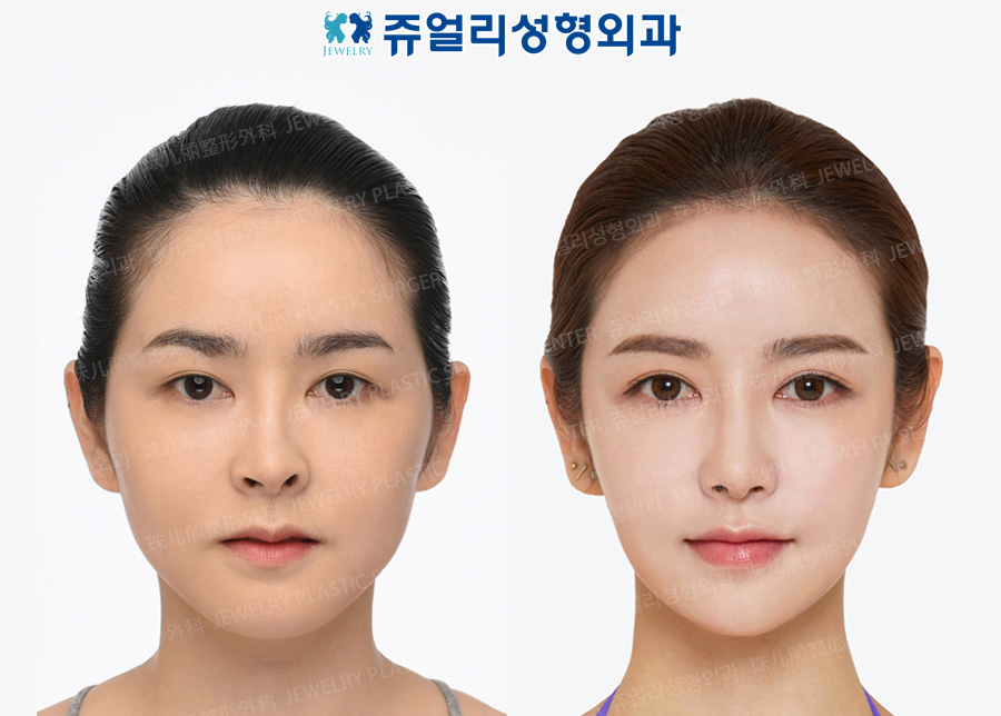 Double Eyelids Reoperation, Lateral Canthoplasty, Lower Lateral Canthoplasty, Nose Reoperation+Nostril Correction, Fat Grafting, Cheekbone Reduction+Square Jaws Reduction+T-osteotomy