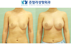 Breast Augmentation