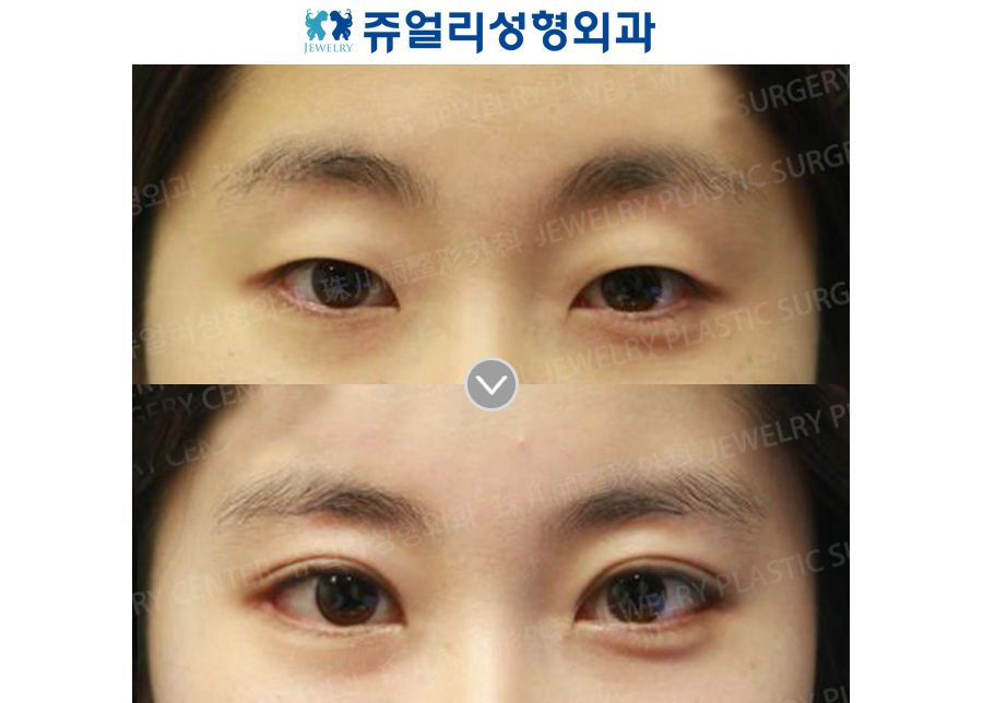 Double Eyelids Non-Incision