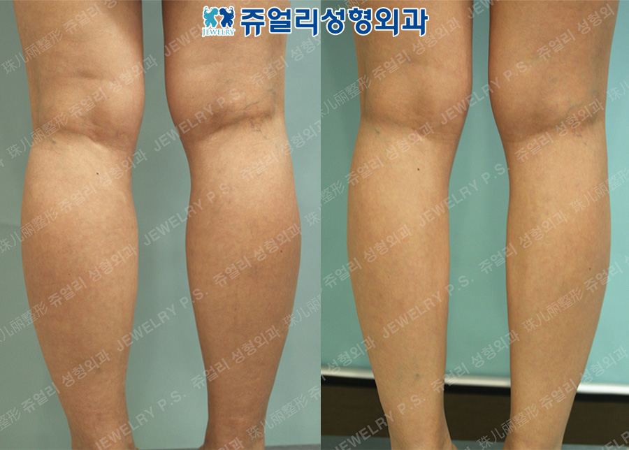 Calf Size Reduction High-Frequency (Nerve Block)