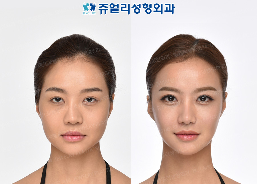 Double Eyelids (Ptosis), Dark Circle Removal (Loveband), Nose (Reoperation), Fat Grafting, Cheekbone Reduction+Square Jaws Reduction+T-osteotomy