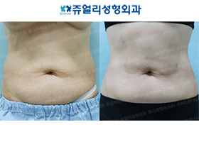 Abdominal Wall Surgery + Liposuction