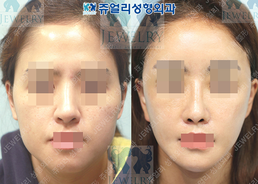 Revision rhinoplasty (autologous rib cartilage) + facial contouring (zygoma, square jaw, front chin) + mini S-lift