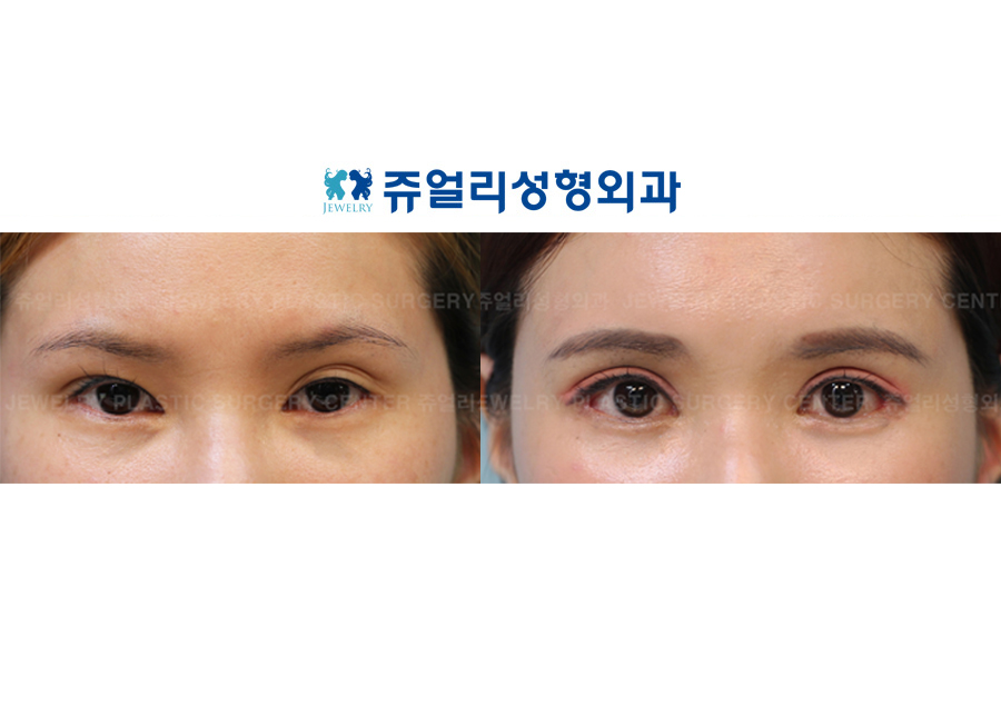 Ptosis (Eyes Enlargement)+Lateral Canthoplasty+Lower Lateral Canthoplasty+Dark Circle Removal (Fat-Repositioning)
