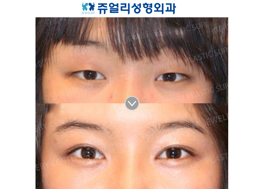 Double Eyelids Non-Incision