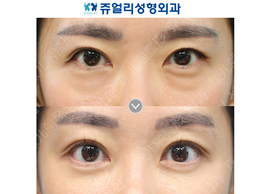 Double eyelid surgery + under-eye fat repositioning