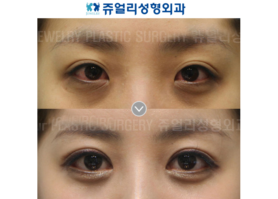 Double Eyelids Non-Incision