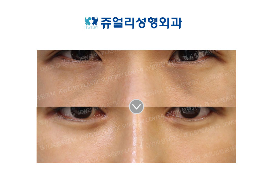 Dark Circles, Loveband