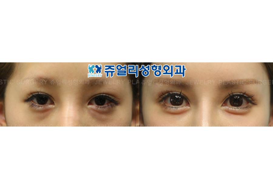 Double Eyelid Incision Reoperation + Ptosis+ Lower Blepharoplasty + Loveband