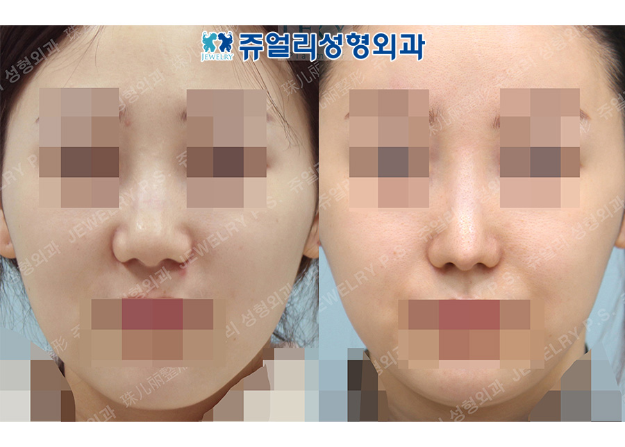 Rhinoplasty (Fix wide nose, alar reduction)