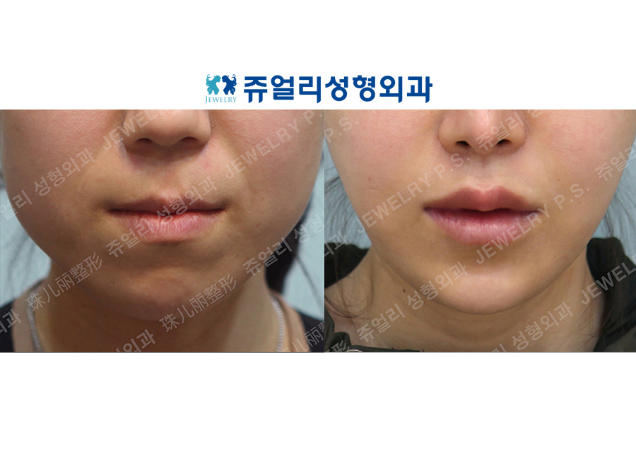 Chin Implant