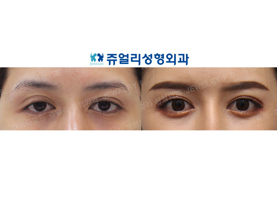 Ptosis correction (Eyes enlargement), Tranconjuctival Blepharoplasty+Loveband